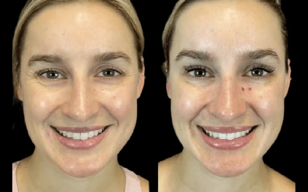 A Complete Beginner’s Guide to Botox Treatment in Dubai