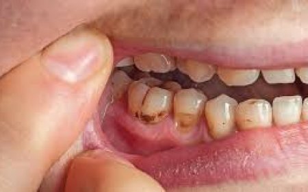 Buy Aspadol for Cavity Pain Relief: What You Need to Know