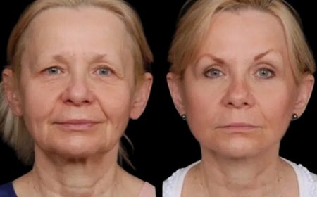 What Makes the Best Doctors in Dubai Experts in Under Eye Fillers?