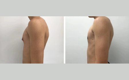 What Makes the Best Doctors in Dubai Ideal for Treating Gynecomastia in Men