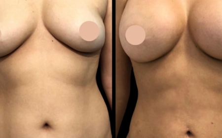Why More Women Are Opting for Breast Augmentation in Dubai in 2025
