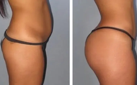 Fat Transfer in Dubai: A Safe and Effective Solution for Body Contouring