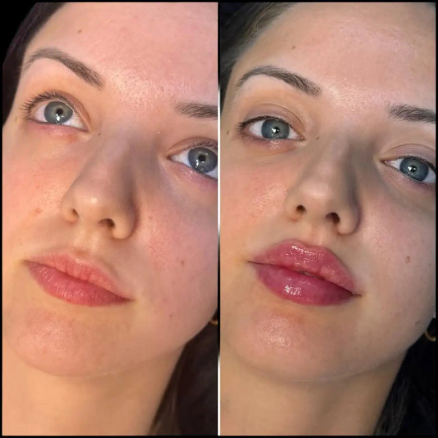 Best Plastic Surgeon in Dubai for Natural Cheek Fillers