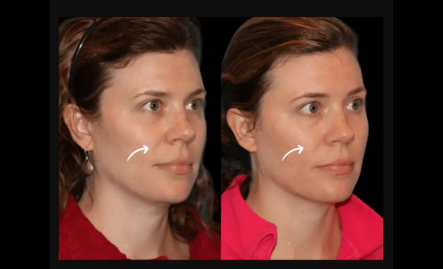 Exclusive Offers for Sculptra Fillers Treatment in Dubai This Summer