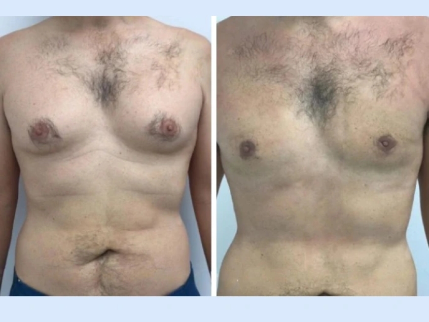 What Sets the Best Gynecomastia Surgeons in Dubai Apart from the Rest Surgeons