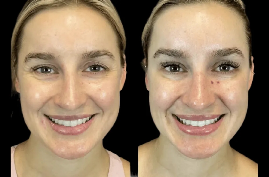 A Complete Beginner’s Guide to Botox Treatment in Dubai