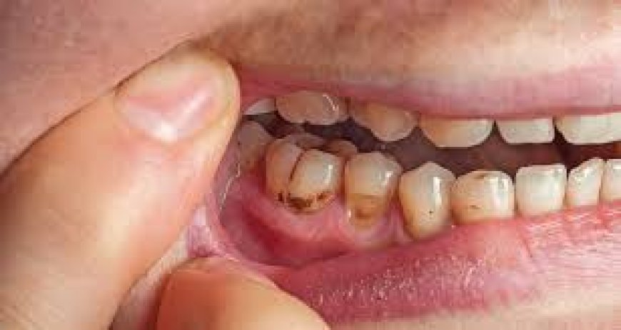 Buy Aspadol for Cavity Pain Relief: What You Need to Know