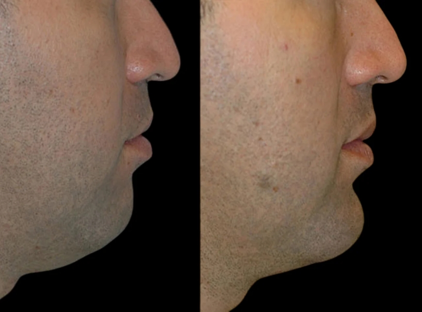 Achieve a Defined Chin with Chin Fillers Treatment in Dubai