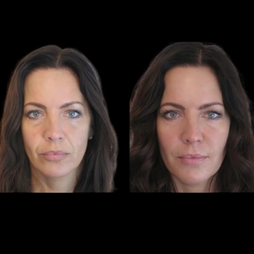 Why Jawline Fillers Treatment in Dubai is the Best Choice for Facial Contouring