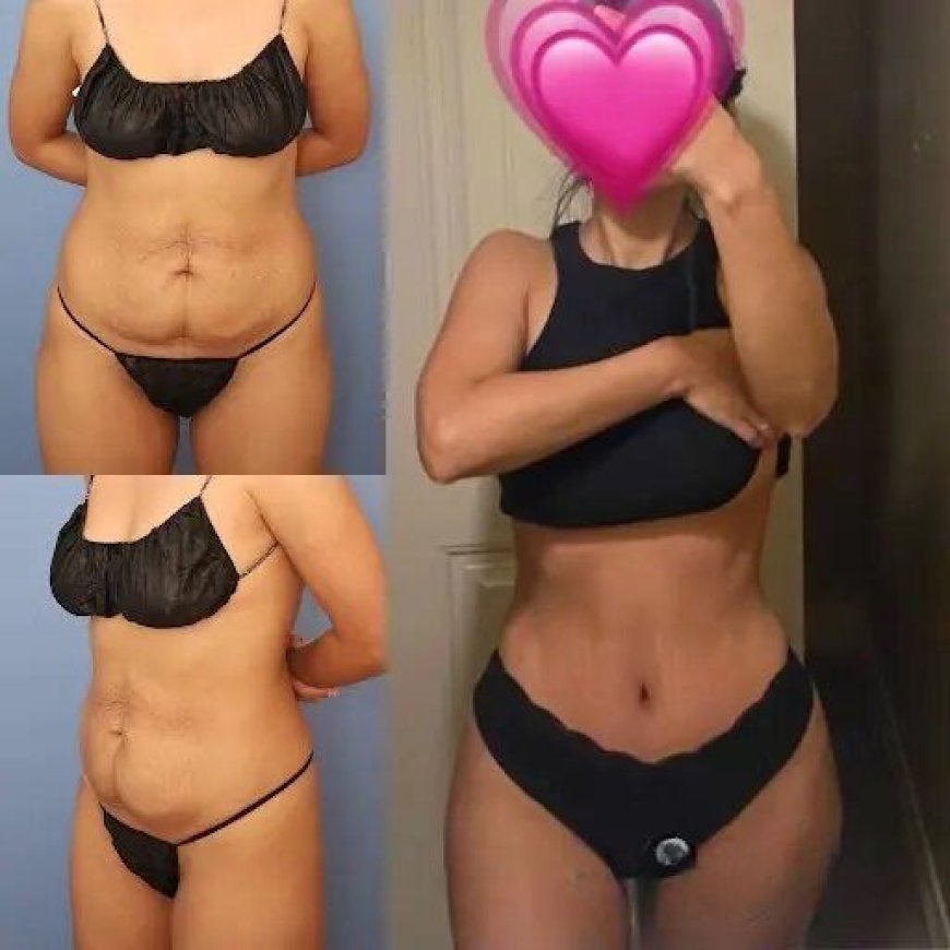 The Best Tummy Tuck Surgeons in Dubai: Transform Your Body with Confidence