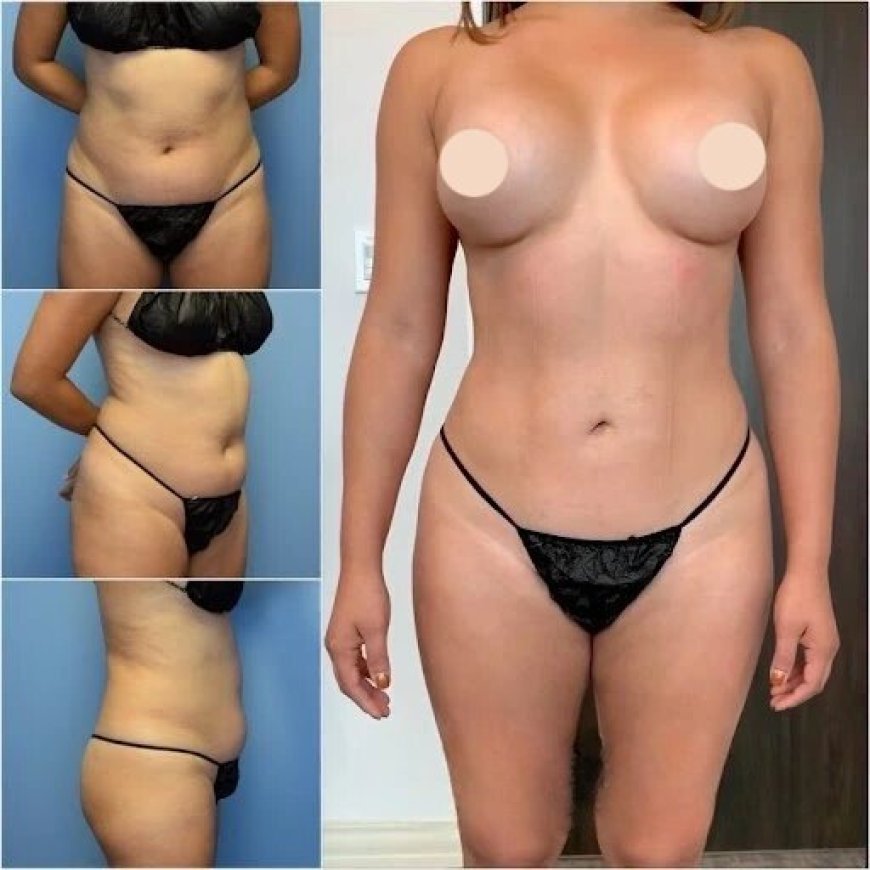 Best Body Contouring Surgeons in Dubai: Achieve a Sculpted Physique with Precision