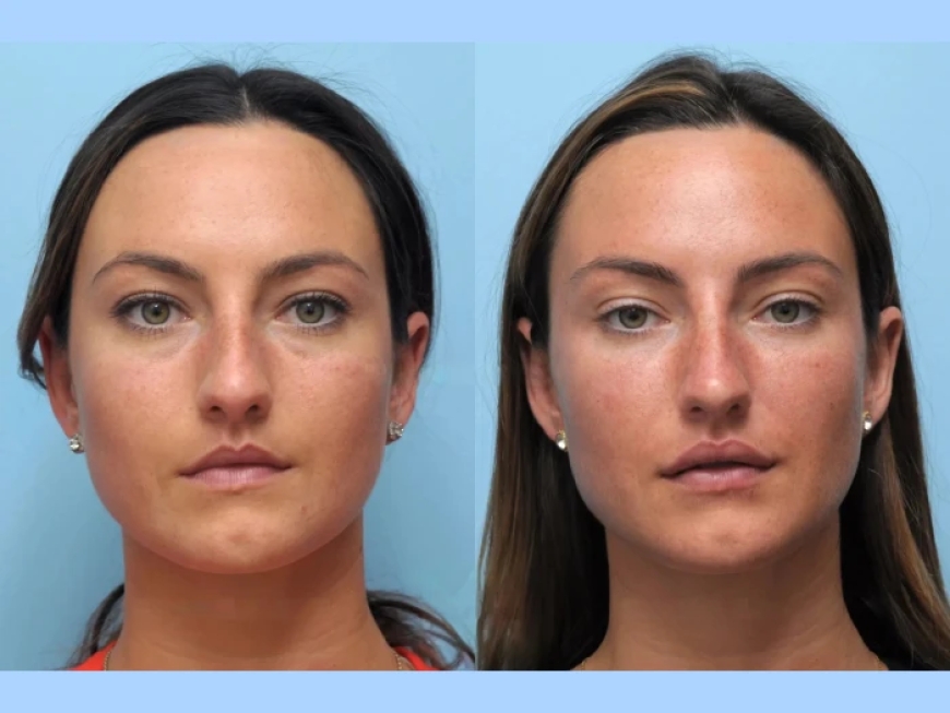 How Thread Lift Treatment in Dubai Enhances Natural Beauty