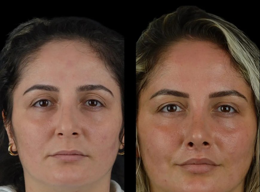 How the Best Doctors in Dubai Stay Informed on New Cheek Fillers Products