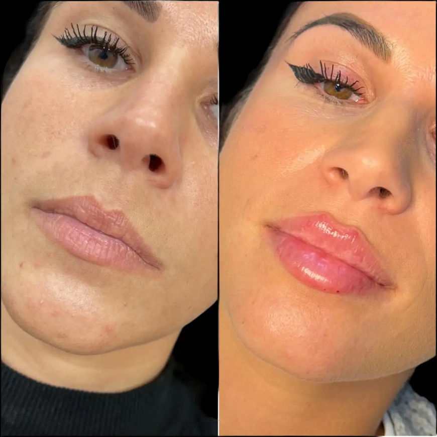 The Best Doctors in Dubai on Managing Expectations for Russian Lip Fillers Patients
