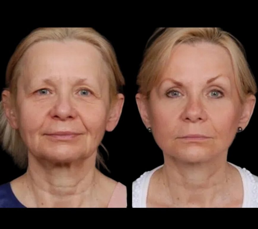 What Makes the Best Doctors in Dubai Experts in Under Eye Fillers?