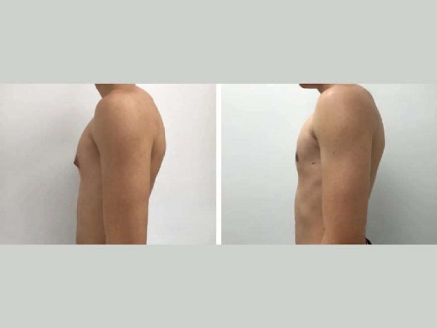 How Hormones Affect Gynecomastia in Dubai’s Male Population