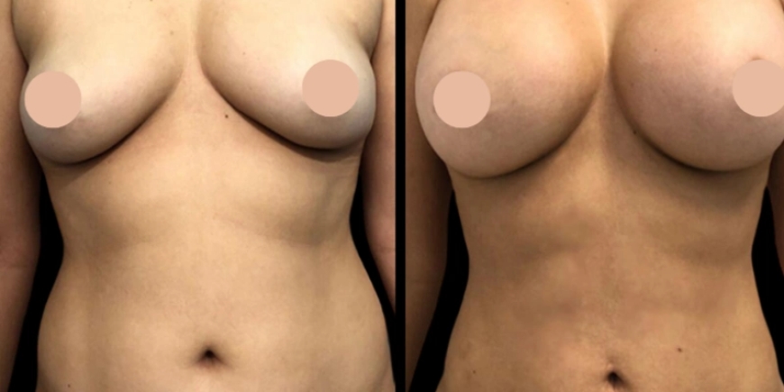 Step-by-Step: Breast Augmentation in Dubai Process Explained