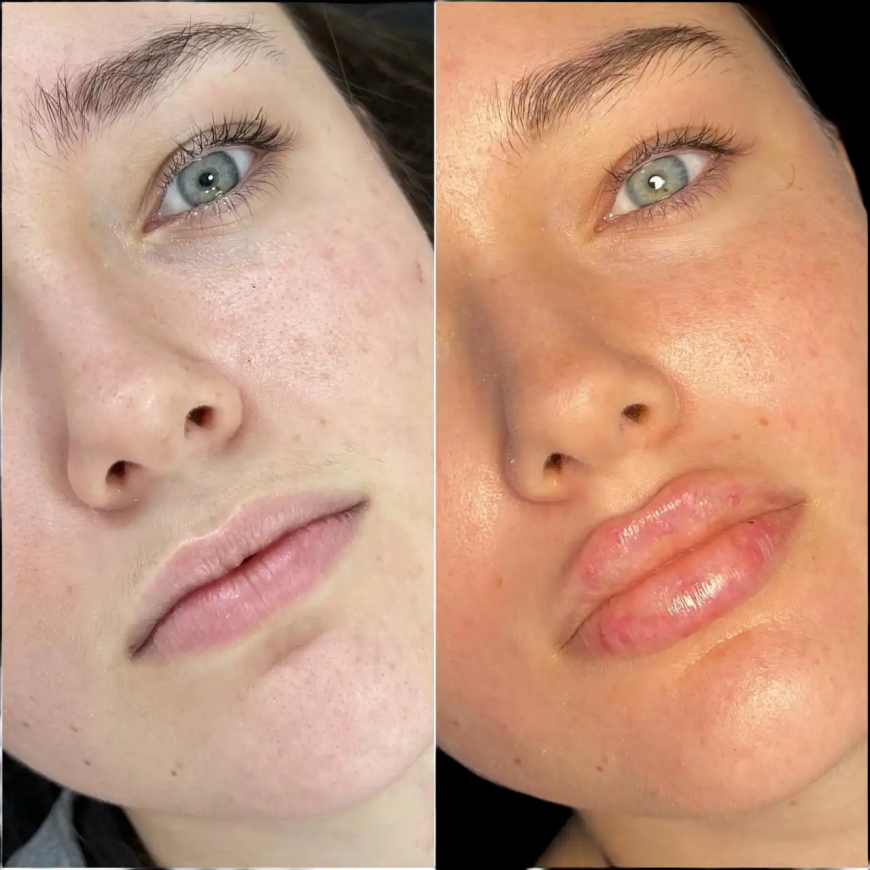 Best Doctors in Dubai for Dermal Fillers: Achieve Natural Results