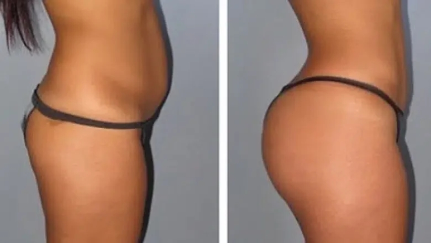 Fat Transfer in Dubai: A Safe and Effective Solution for Body Contouring