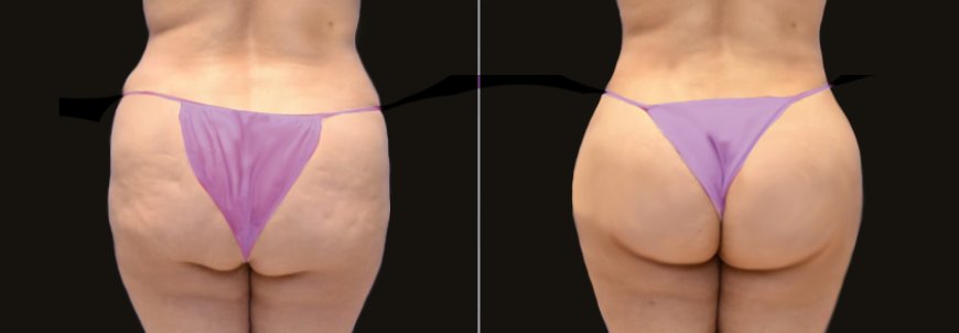 Butt Fat Transfer in Dubai: The Ultimate Guide to a Natural Lift