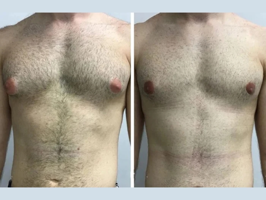Gynecomastia in Dubai: Real Patient Stories and Transformations