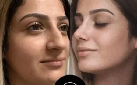 Best Aesthetic Clinic in Dubai for Lip Fillers – What You Need to Know