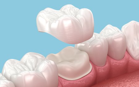 Dental Crowns Dubai: Restore Strength and Beauty to Damaged Teeth