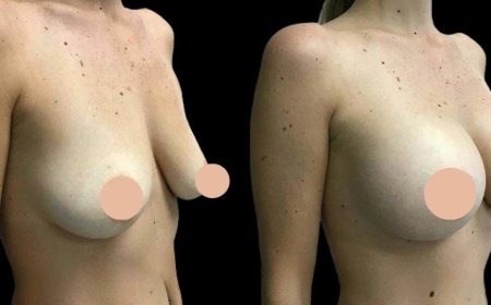 Breast Augmentation in Dubai for a Balanced, Proportional Figure