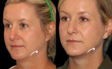 The History of Sculptra Fillers Through the Lens of Best Doctors in Dubai