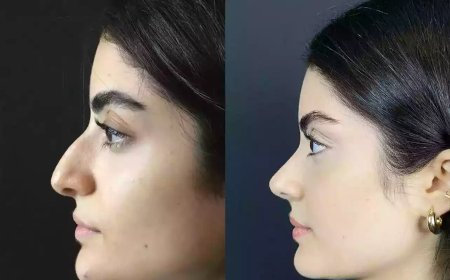 Rhinoplasty Trends by Best Doctors in Dubai