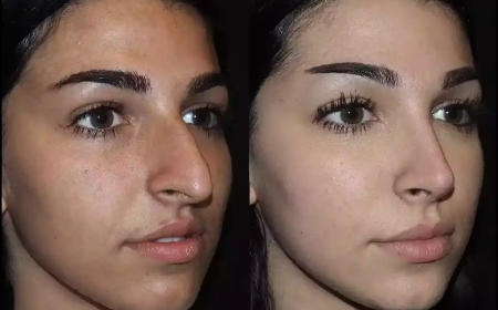 Liquid Rhinoplasty in Dubai: Non-Surgical Nose Enhancement