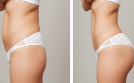 How Butt Fat Transfer in Dubai Can Give You a Natural, Sculpted Look