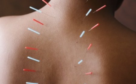 Acupuncture for Menopause Relief: A Natural Way to Rebalance and Restore