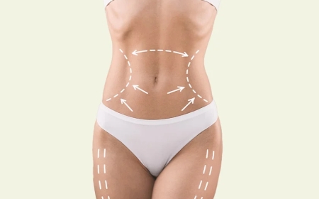 How to Choose the Best Fat Transfer Surgeons in Dubai for Your Desired Results