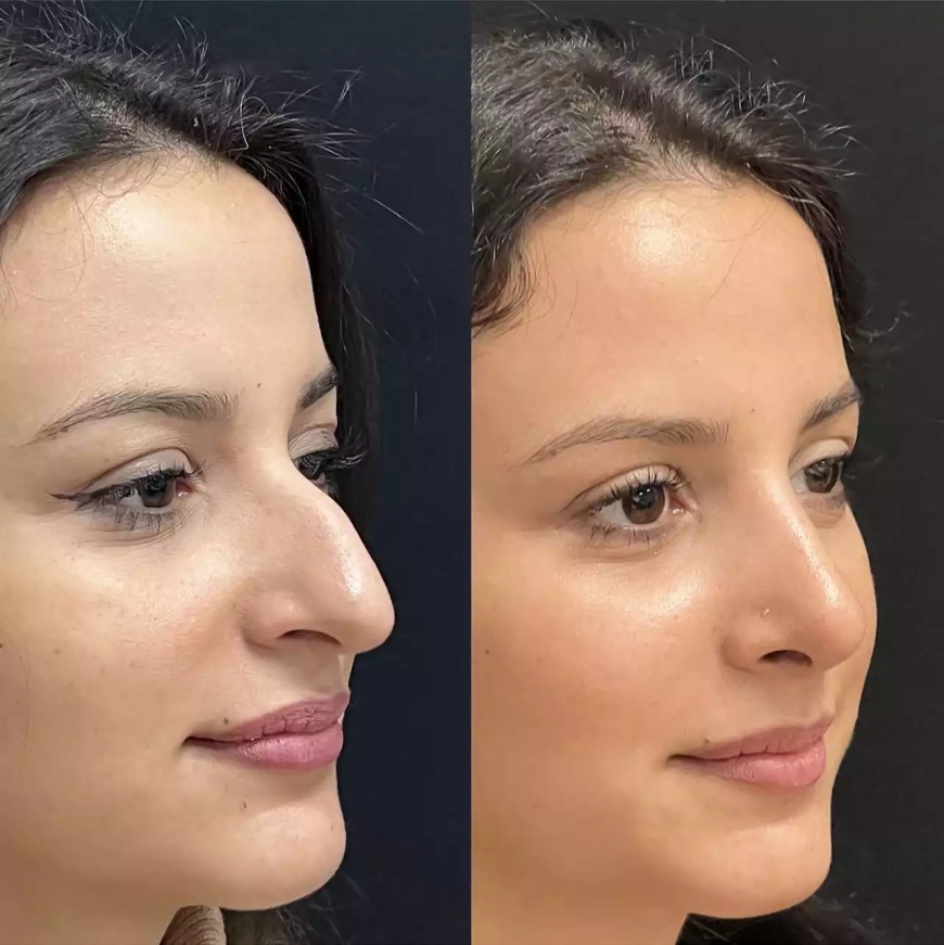 Common Myths About Nose Surgery in Dubai