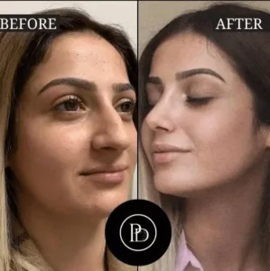 Best Aesthetic Clinic in Dubai for Lip Fillers – What You Need to Know