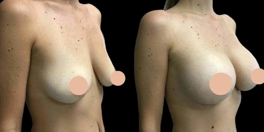 Breast Augmentation in Dubai for a Balanced, Proportional Figure