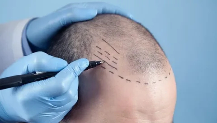 Crowning Glory Restored: Finding the Best Hair Transplant Surgeon in Lahore
