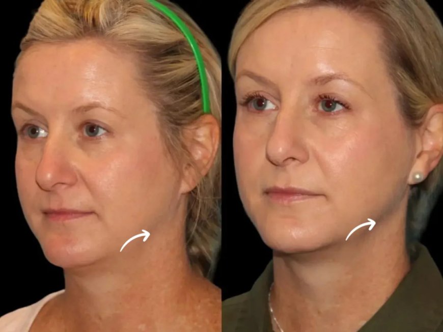The History of Sculptra Fillers Through the Lens of Best Doctors in Dubai