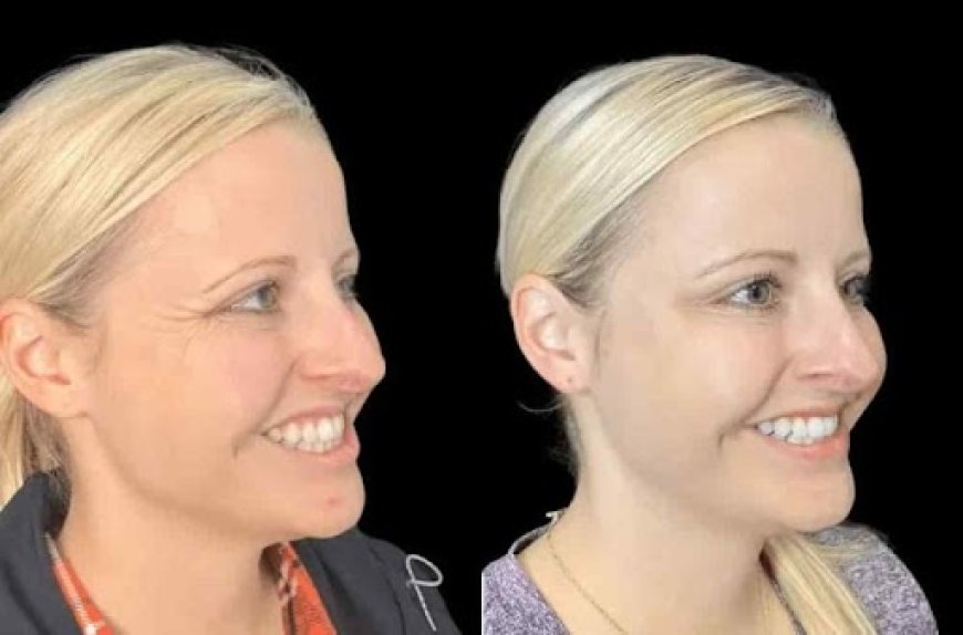 Best Doctors in Dubai for Botox Known for Exceptional Results