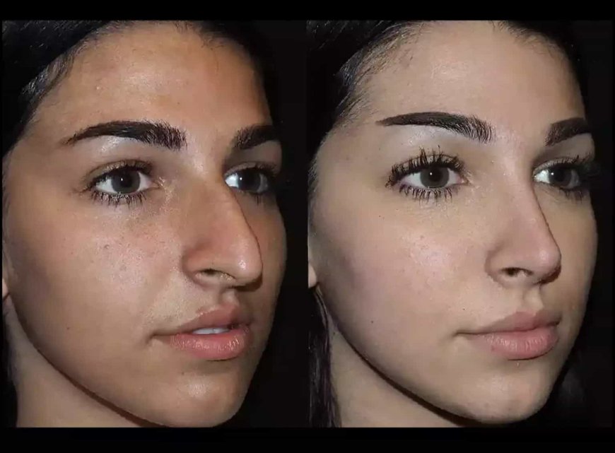 Best Doctors in Dubai for Blocked Nose Surgery