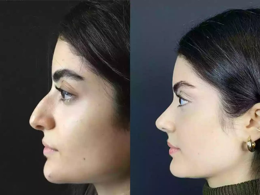Rhinoplasty Trends by Best Doctors in Dubai