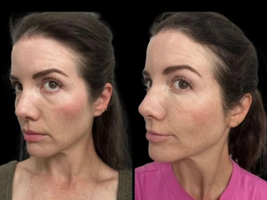 Best Aesthetic Clinic in Dubai: How to Choose the Right Treatment for Your Dark Circles
