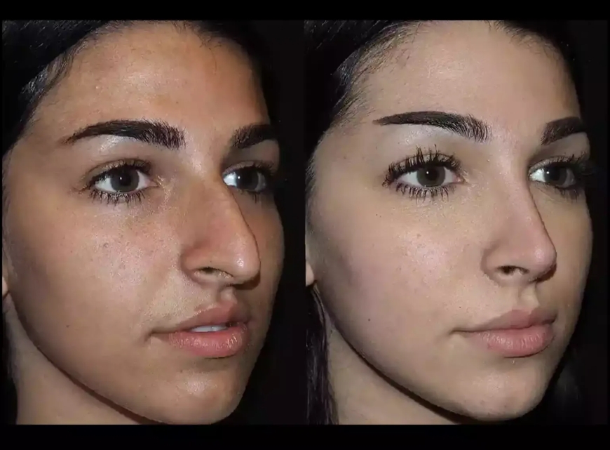 Liquid Rhinoplasty in Dubai: Non-Surgical Nose Enhancement