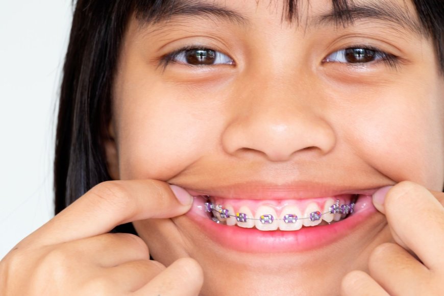 Ortodoncia Invisible en Barcelona Sonrisa Perfecta sin Brackets