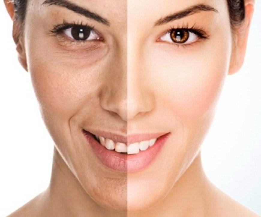 Dermal Fillers vs Botox: Which One Suits Your Skin Goals?