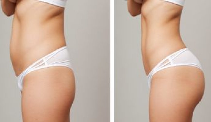 How Butt Fat Transfer in Dubai Can Give You a Natural, Sculpted Look