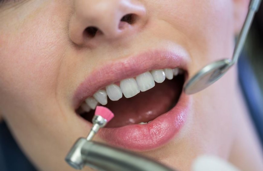 Is Dental Bonding Right for Your Oral Health? Here’s What You Should Know